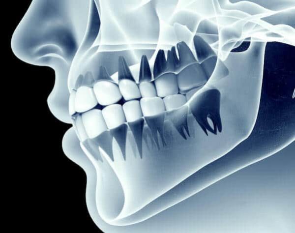bone-grafting-adentaloffice bone-grafting-adentaloffice