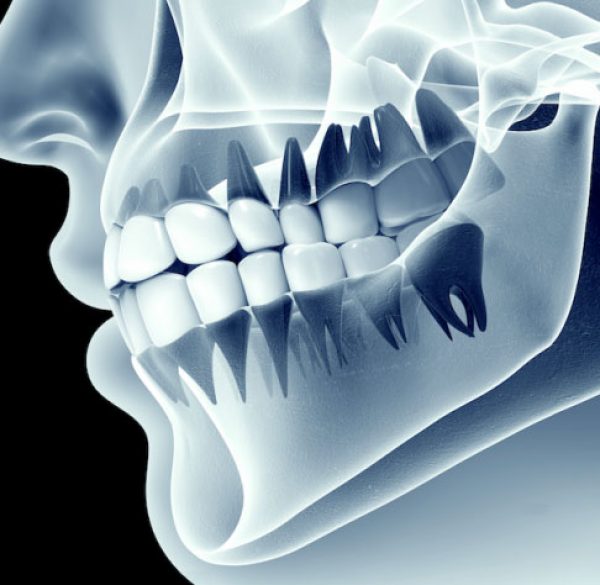 bone_grafting1487710323-1 copy