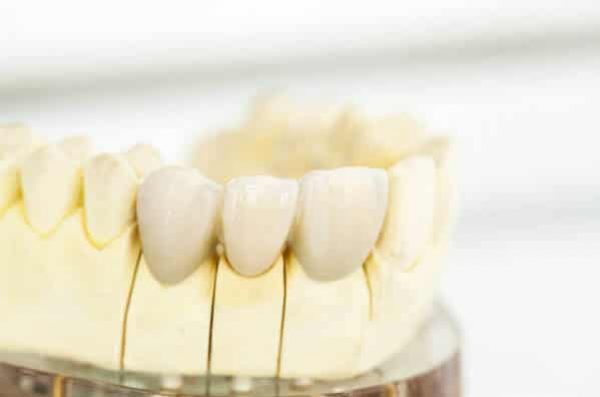 crown-lengthening-adentaloffice crown-lengthening-adentaloffice