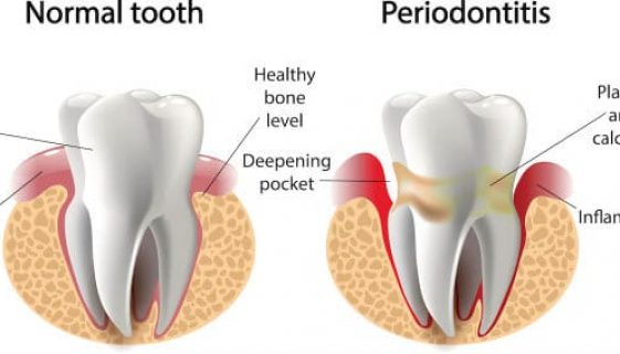 periodontal-gum-therapy-adentaloffice periodontal-gum-therapy-adentaloffice