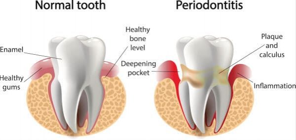 periodontal-gum-therapy-adentaloffice