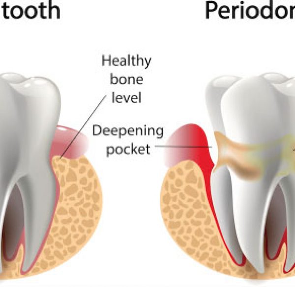 periodontal_gum_therapy1487865768-1 copy