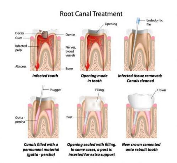root-canal-treatment-adentaloffice root-canal-treatment-adentaloffice