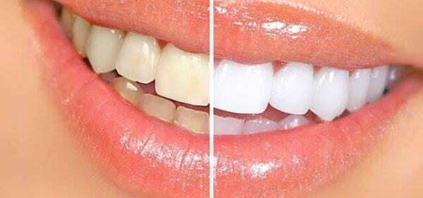 teeth-whitening-adentaloffice teeth-whitening-adentaloffice
