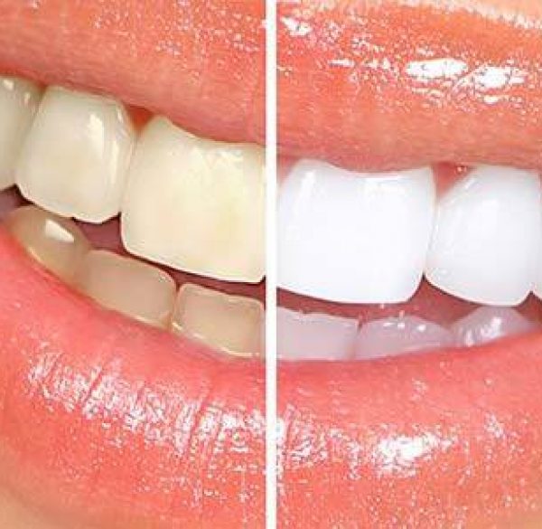 teeth_whitening_121487089652-1