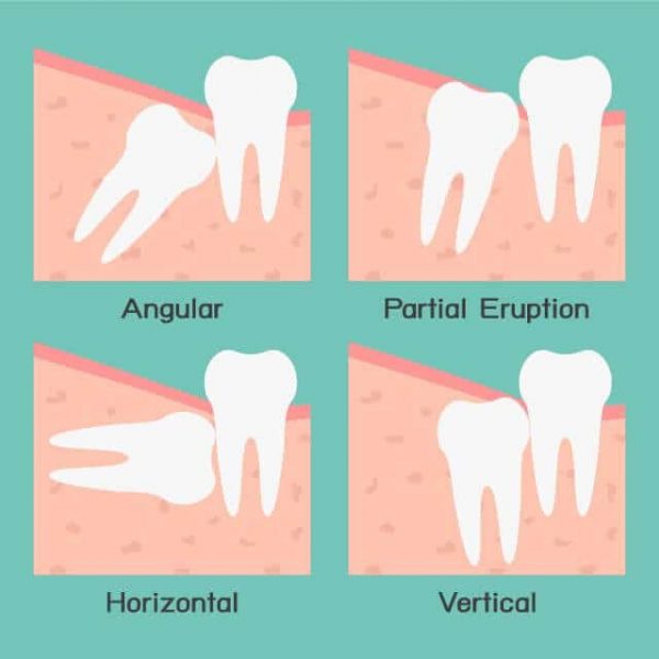 wisdom-teeth-removal-adentaloffice wisdom-teeth-removal-adentaloffice