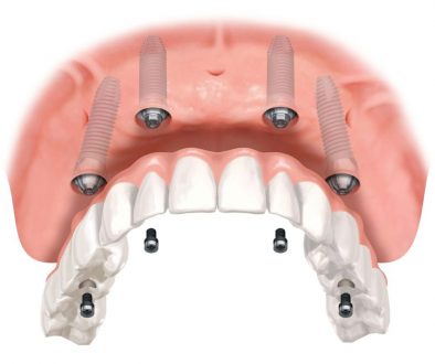 dentures-adentaloffice