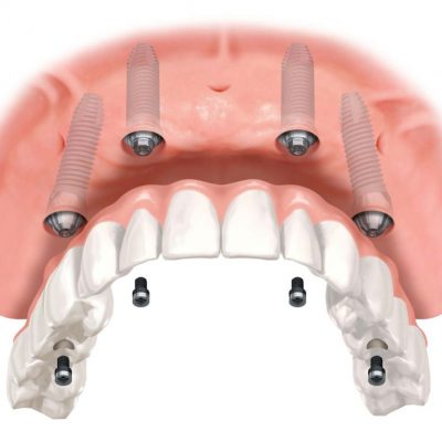 dentures-adentaloffice