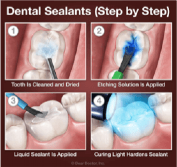 dental-sealants-adentaloffice dental-sealants-adentaloffice