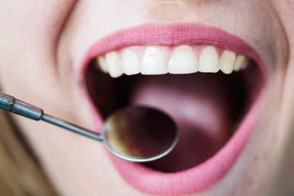 canker-sores-adentaloffice canker-sores-adentaloffice