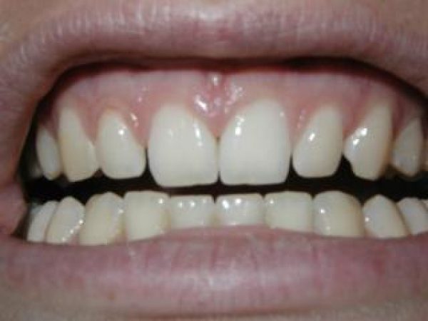 grind-teeths-adentaloffice grind-teeths-adentaloffice