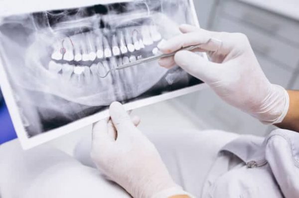 wisdom-teeth-new-adentaloffice wisdom-teeth-new-adentaloffice