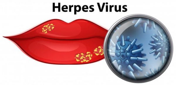 herpes-virus-cold-sores-adentaloffice