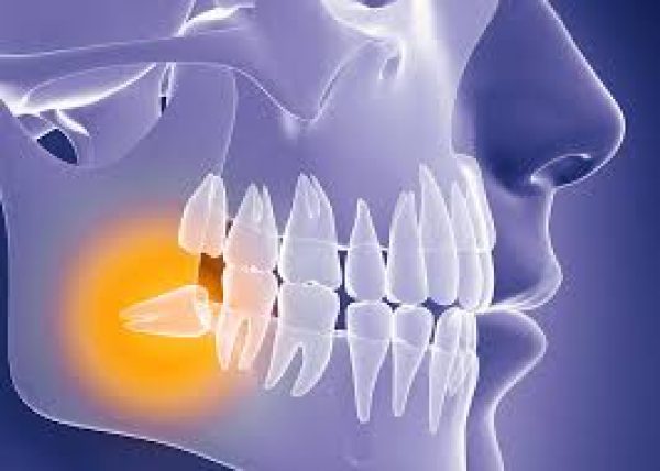wisdom-teeth-adentaloffice wisdom-teeth-adentaloffice
