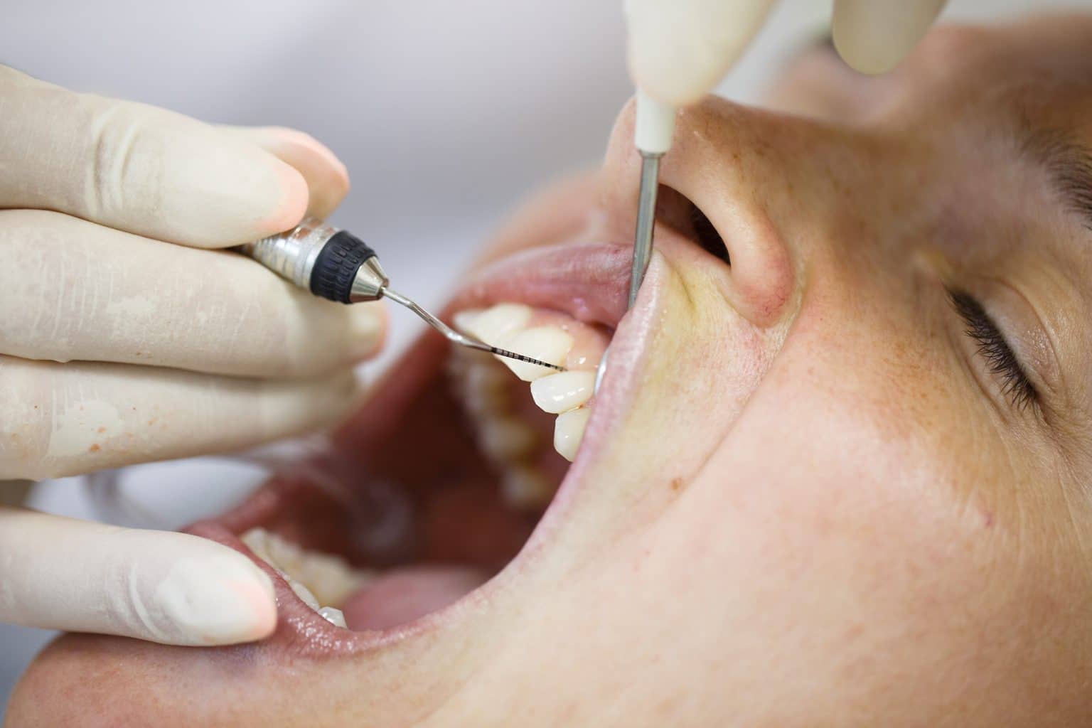 Dental Probing And Your Gums